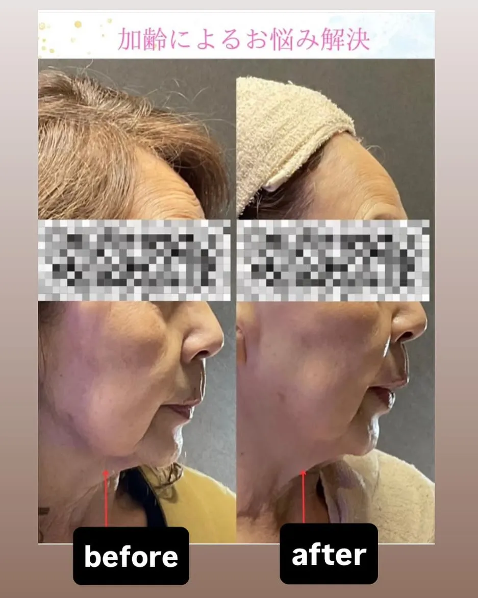 今当サロンで大人気の韓国から来たリフショック‼️